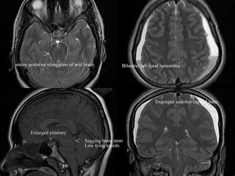 Dr Balaji Anvekar FRCR: Intracranial hypotension MRI