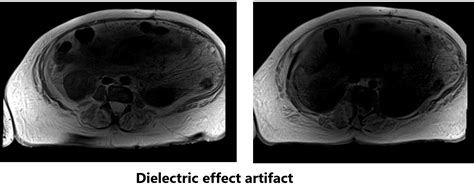 Dielectric Effect Artifact Mri Dielectric Effect Artifact