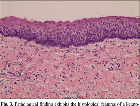 Nevoid Basal Cell Carcinoma Syndrome Histology