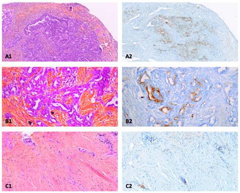 Anatomopathological Examination Of Primary And Peritoneal Lesions Of