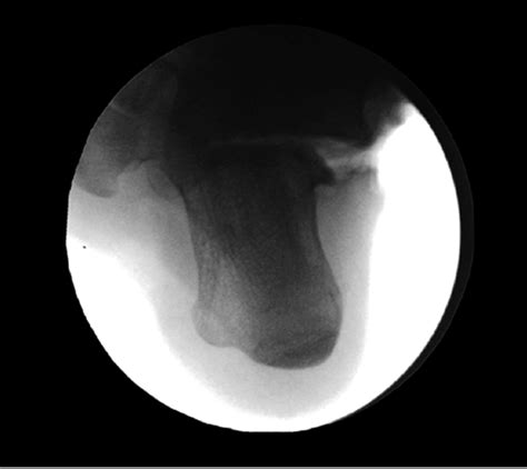 Technique Article Tarsal Coalition Resection Using Kirschner Wires