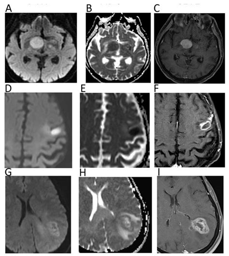 Cancers Free Full Text Diffusion Weighted Imaging In Oncology An