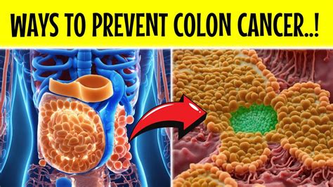 Top Ways To Prevent Colorectal Cancer Prevention Best Strategy To