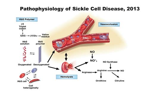 Ppt Sickle Cell Disease Powerpoint Presentation Free Download Id3352623