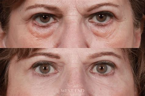 Upper Blepharoplasty Before After