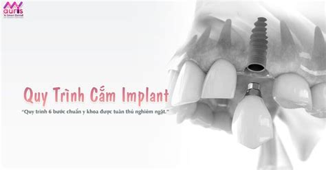 Quy trình cắm implant theo tiêu chuẩn Y khoa Nha Khoa My Auris Implants