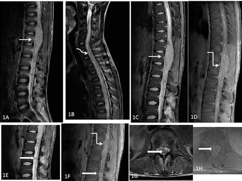 Figure 1 From Imaging Features Of Intramedullary Spinal Cord Lesions