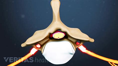 Cervical Foraminal Stenosis