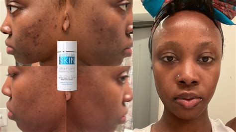 Diminish Dark Spots Hyperpigmentation And Uneven Skin Tone Fast With