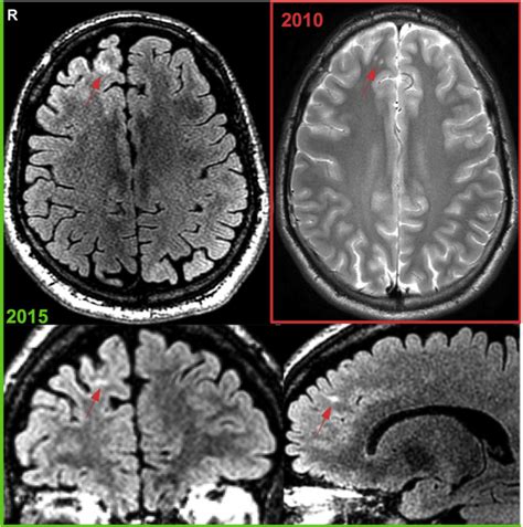 Patient 65 Fcd Gliosis In Right Superior Frontal Gyrus Diagnosis