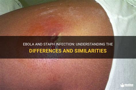 Ebola And Staph Infection Understanding The Differences And