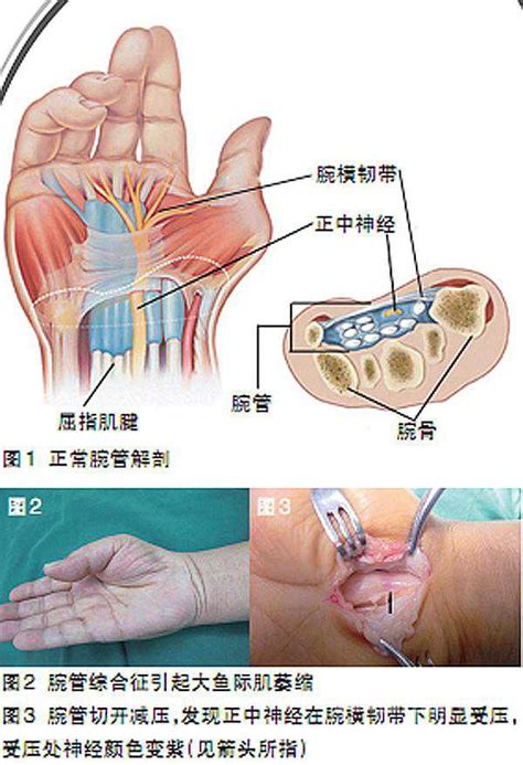 一图学会预防腕管综合征 Medscicn