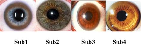 Figure 3 from An Algorithm to Detect Kayser-Fleischer Ring in Human Eye ...