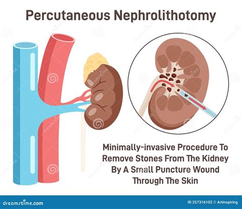 Percutaneous Nephrolithotomy Kidney Stone Removing Surgery