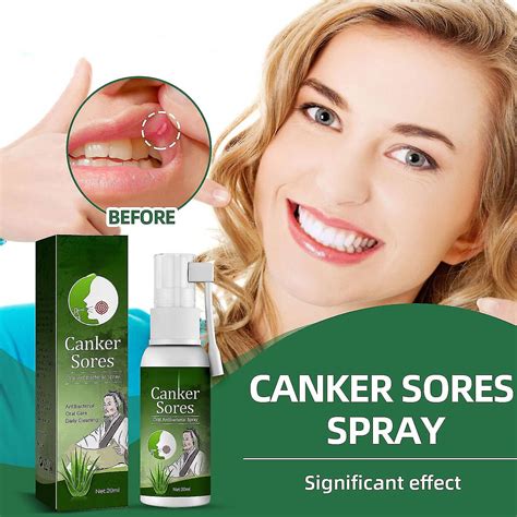 Canker Sore Relief Spray Mouth Ulcer Treatment Spray Canker Sore Treatment Spray Oral Care