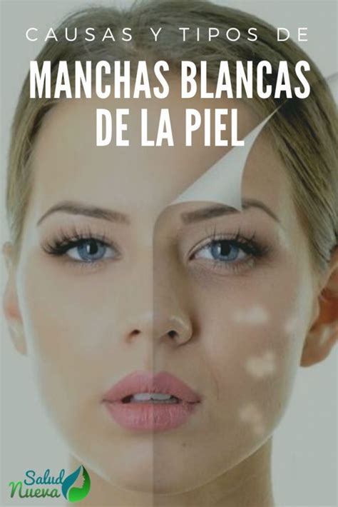 ¿por Qué Tenemos Manchas Blancas En La Piel