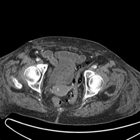 MRI scan pelvis - DocCheck