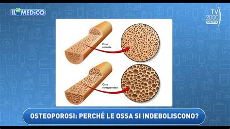 Il Mio Medico TV2000 Come Valutare La Salute Delle Ossa E Prevenire