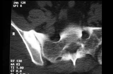 Case 2: computed tomography on the right iliac bone. | Download ...