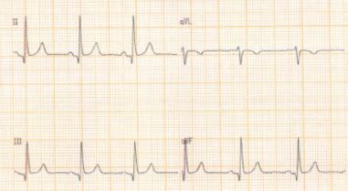 Eletro Normal E Alterado - Eletrocardiograma normal: a base para entender alterações - Medway