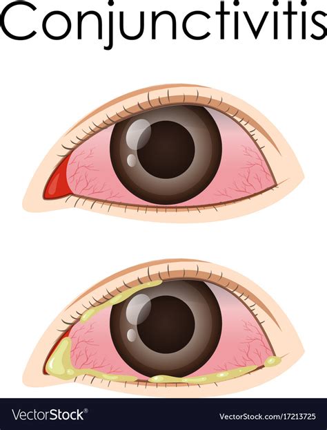 Diagram Showing Conjunctivitis In Human Royalty Free Vector