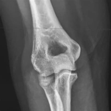 Fracture tête radiale Var Membre Supérieur