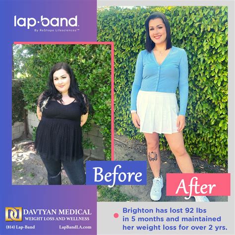 Lap Band La Lap Band Procedure And Lap Band Surgeons Los Angeles