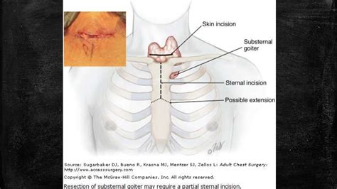 Mediastinal tumor