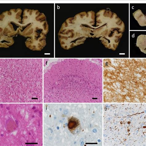 Histopathology Diffuse Marked Cerebral Atrophy A B And Download Scientific Diagram