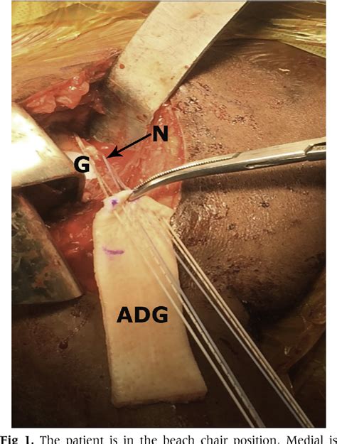 Figure 1 from Anterior Capsule Reconstruction for Irreparable ...