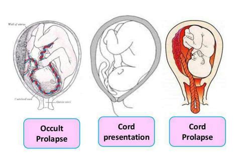 Solution Umbilical Cord Prolapse Studypool