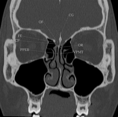 Crista Galli Anatomy