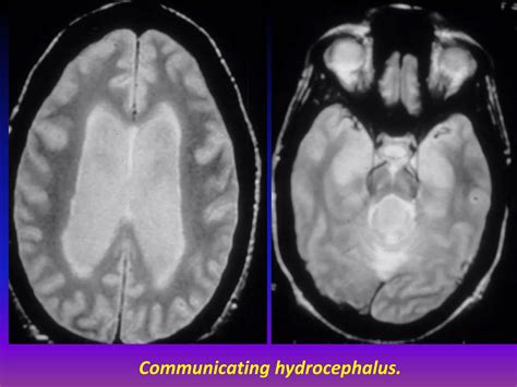 Presentation1pptx Radiological Imaging Of Hydrocephalus Ppt