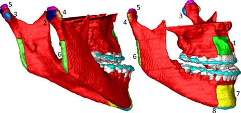 One Year Assessment Of Surgical Outcomes In Class Iii Patients Using Cone Beam Computed