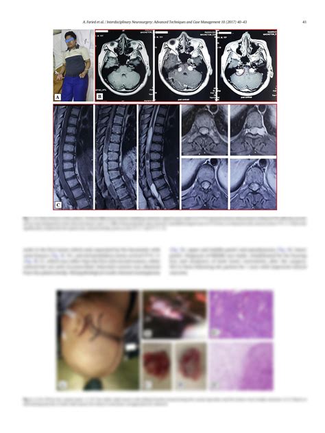 Solution Multiple Inherited Schwannomas Meningiomas And Ependymomas