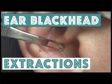 Best Dr Pimple Popper Blackhead Extraction Videos Ever | Blackheads ...