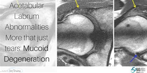 Acetabular Labrum Mri