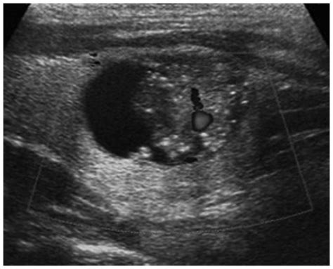 papillary thyroid cancer ultrasound colors - Pillar Of Society Bloggers ...