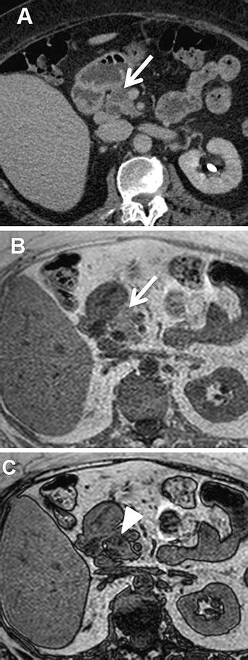 Focal Fatty Replacement In The Pancreatic Head In A 69 Year Old Female