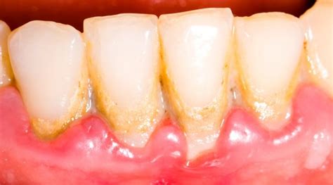 Qué es el sarro dental y cuáles son sus consecuencias Estudi Dental