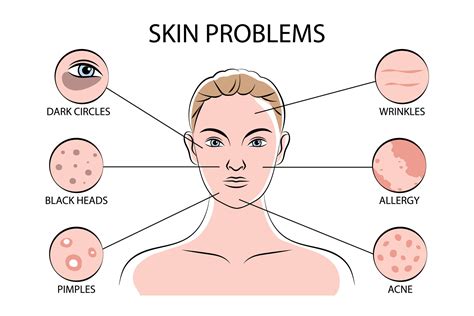 Skin Problems Infographics 5751419 Vector Art at Vecteezy