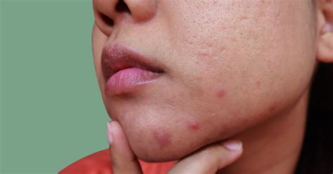 Polycystic Ovarian Syndrome Acne