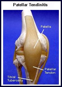 Patellar Tendonitis | Knee Pain Info