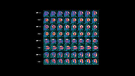 Pet Ct Delineation Of Multivessel Coronary Artery Disease And Post