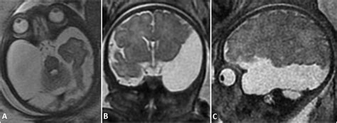 Prenatal Diagnosis Of Arachnoid Cysts Mri Features And