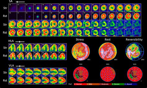 Relative Perfusion Imaging With Rb Pet Stress Rest Rubidium Pet