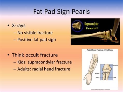 Imaging In Fractures