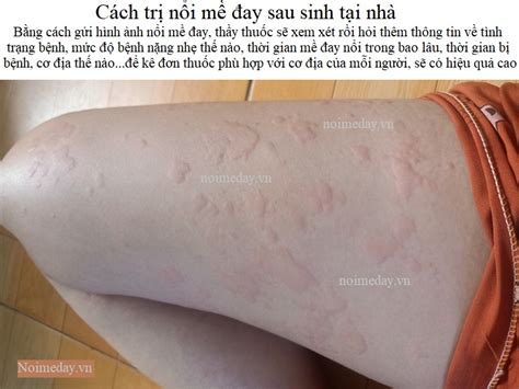 Cách Trị Nổi Mề đay Sau Sinh