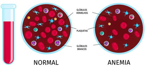 5 principais sintomas da anemia O que é e sinais importantes