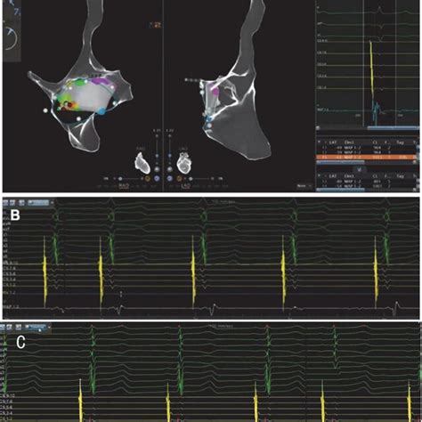 A CARTO Electroanatomical 3 Dimensional 3D Mapping System Showing